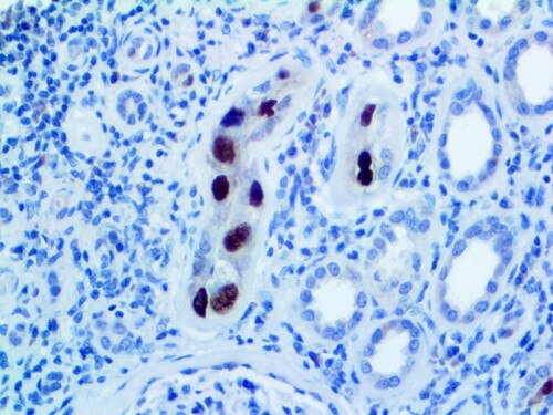 IHC of SV40 on an FFPE Infected Kidney Tissue